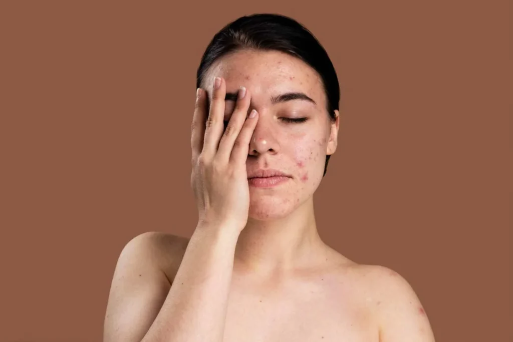 Acne care for an acne-free lifestyle