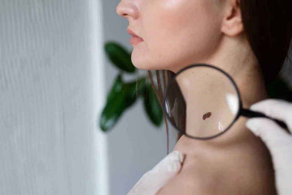 When and How Should You Remove Moles